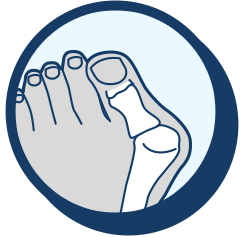 Bunions Removal, Surgery & Alternatives, Treatment & Recovery in Chandler & Gilbert, Arizona