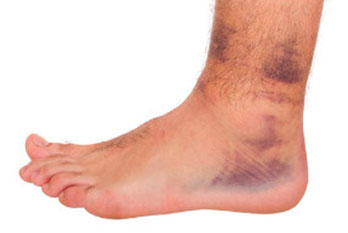 sprained-ankle