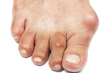 Bunions removal in the Maricopa County, AZ: Chandler(Dobson Ranch, Kiwanis Park, Tempe, Ocotillo, Sun Lakes, Goodyear Village, Guadalupe, Ahwatukee, Mountain Park Ranch) and Gilbert (The Islands, Val Vista Lakes, Superstition Springs, Reed Park, Power Ranch, Mesa, Queen Creek, Eastmark, Kleinman Park Neighborhood, Lower Santan Village) areas