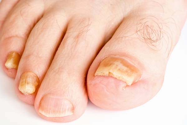 Nail Fungus
