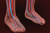 Diabetes and Poor Circulation in the Feet