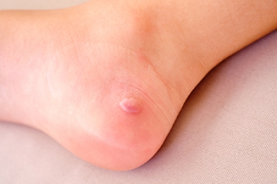 Chilblains May Cause Foot Blisters in Winter