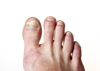 Discoloration and Toenail Fungus