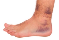 Causes and Treatment of a Sprained Ankle