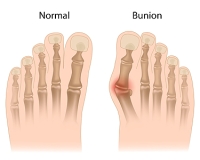 Men and Bunions