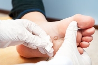 How Are Foot Warts Removed?